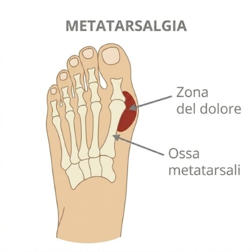 Metatarsalgia: dolore cronico nella parte anteriore del piede, indicazione per calzature ortopediche con supporto metatarsale